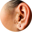auriculoterapia